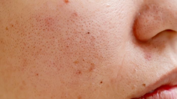 PCOS and Acne Why It Keeps Coming Back (and What Actually Helps)